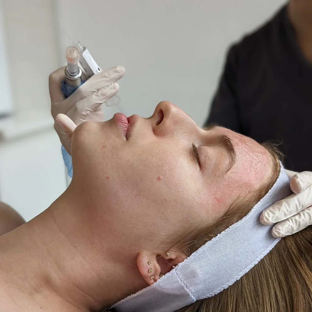 What Are the Benefits of eDermaStamp Microneedling?