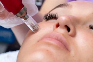 How Often Should I Get Microneedling