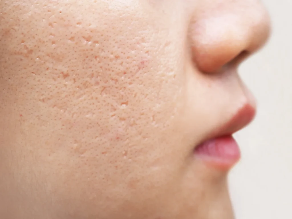 What Is Better for Acne Scars: Microdermabrasion or Microneedling